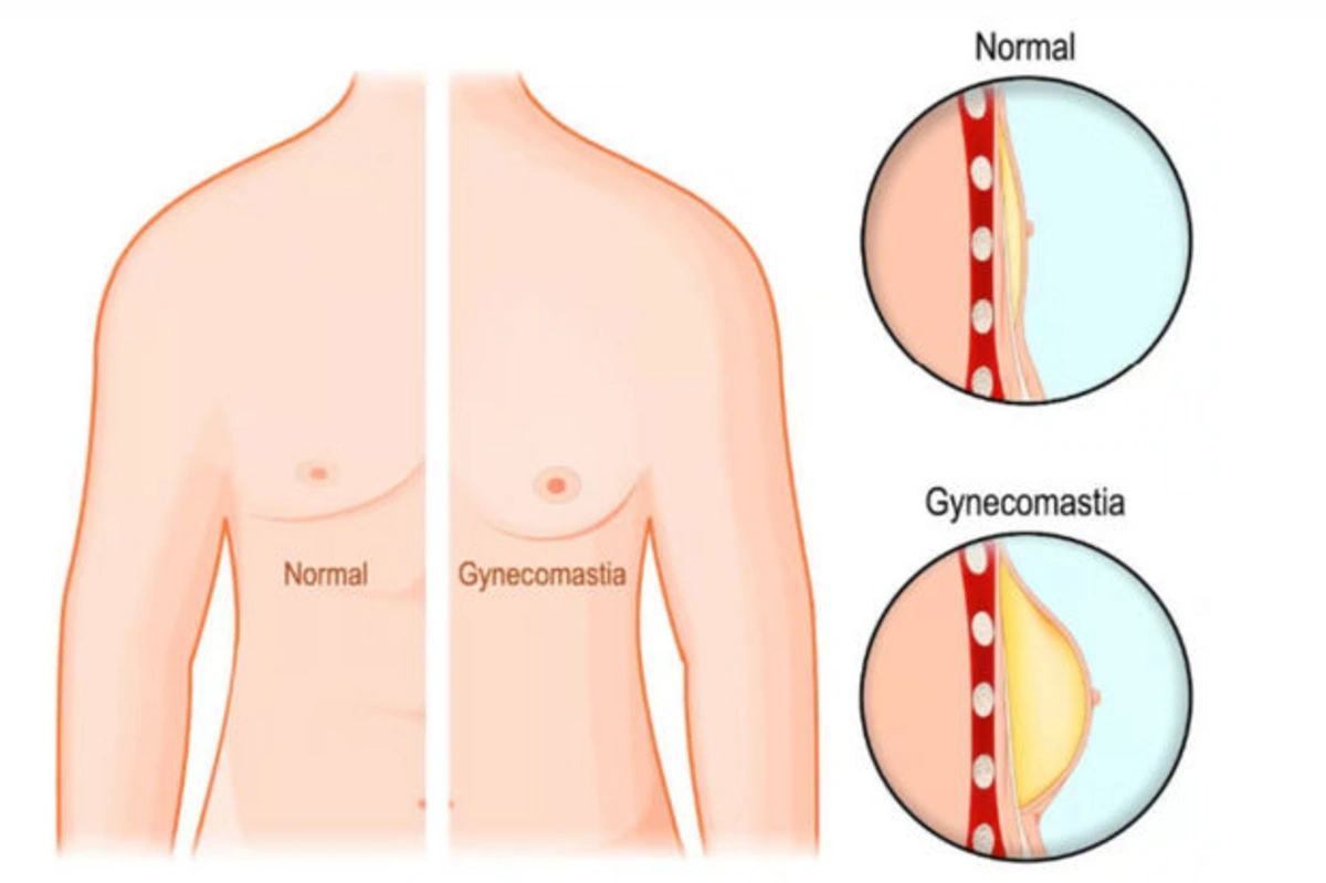 Аномальный рост груди у мужчин: как избавиться от гинекомастии? - ЗАЯВЛЕНИЕ  + ВИДЕО - Oxu.az