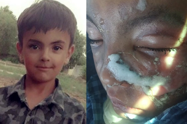 Восьмилетний Абульфаз получил тяжелые ожоги: ребенку требуется помощь