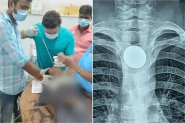 СМИ: Индийский мальчик семь лет жил с монетой в горле