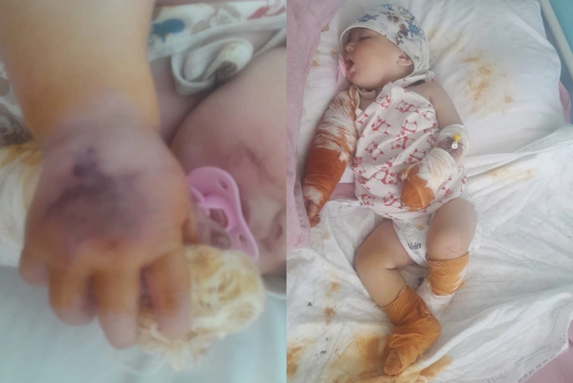Годовалый Кямран получил тяжелые ожоги: малышу необходима помощь