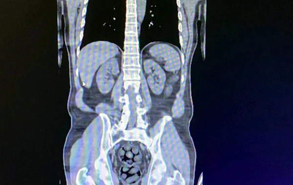 İranlı 3 yolcunun mide ve bağırsaklarından uyuşturucu madde çıktı